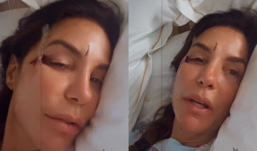 Ivete Sangalo mostra rosto com ferimentos após desmaiar em casa; cantora está internada em Salvador